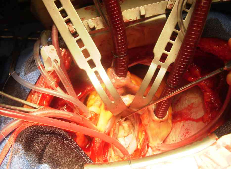 heart bypass operation